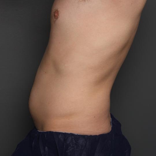 fat injection