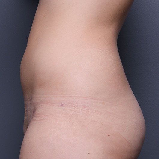 liposuction