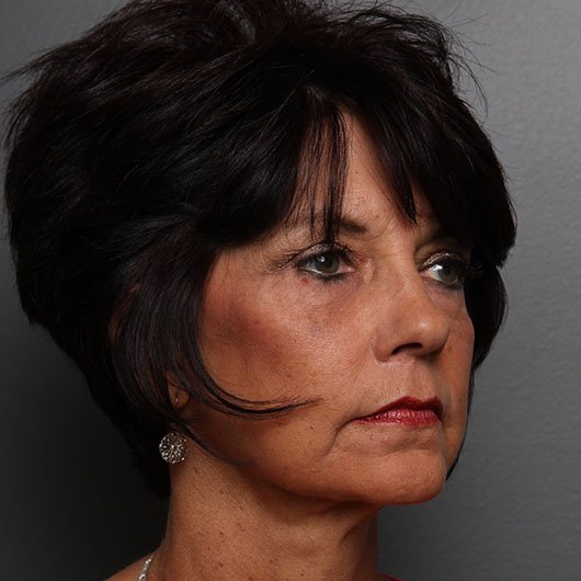 face lift