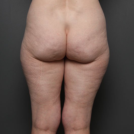 liposuction