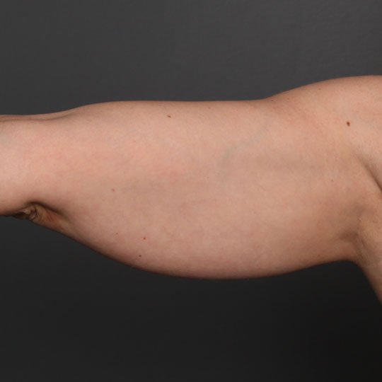 fat injection