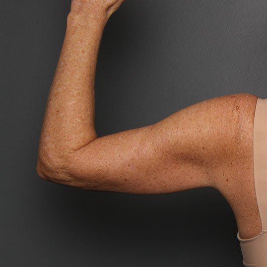 arms