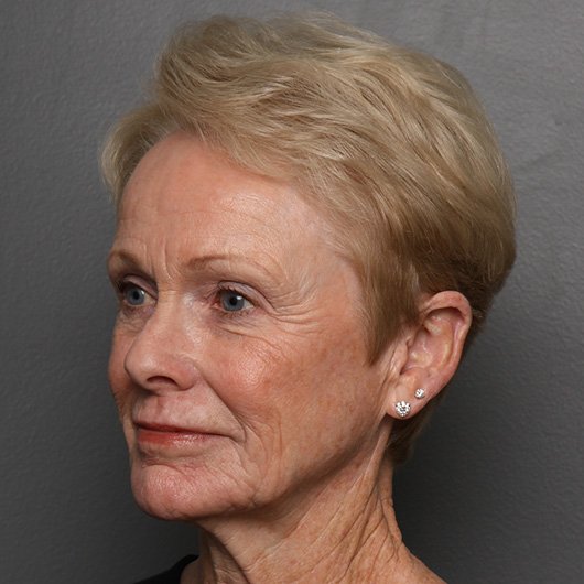 facelift