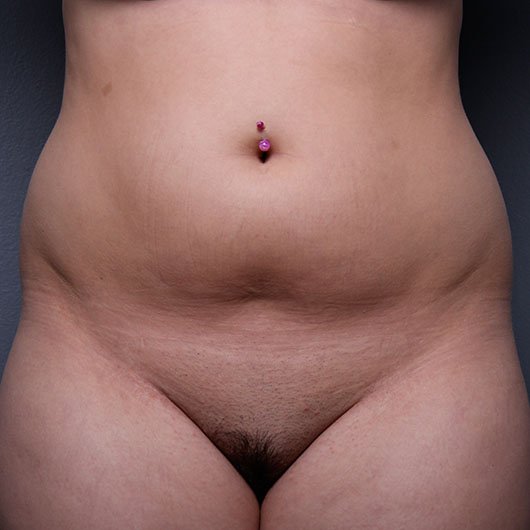 liposuction