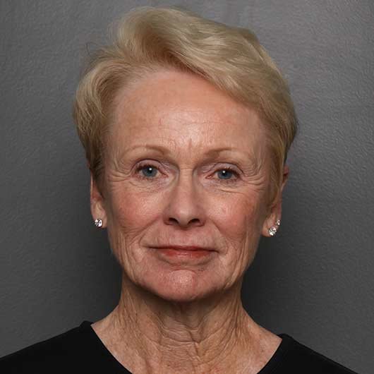 facelift
