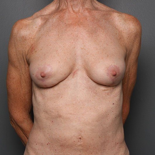 fat injection