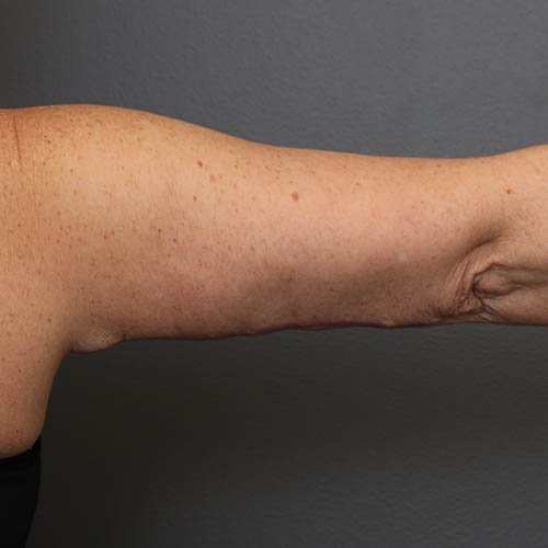 Liposuction