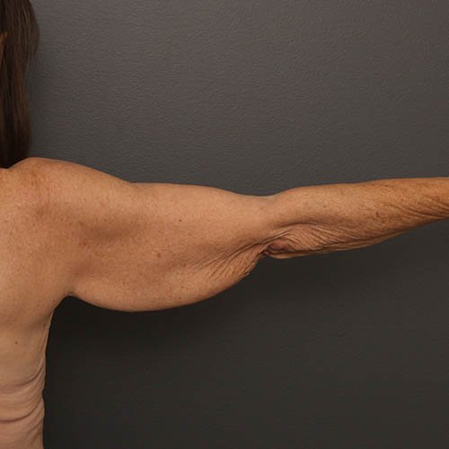 arms