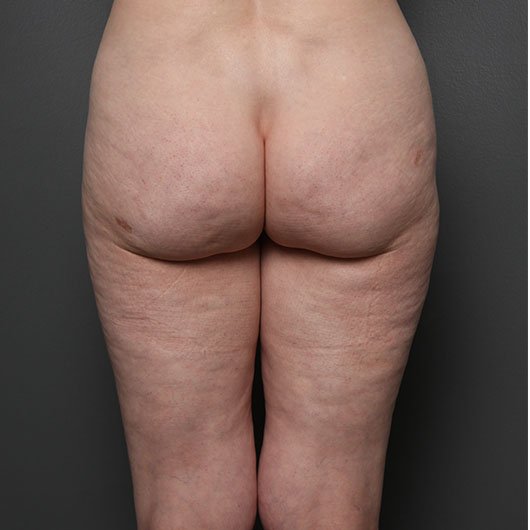 liposuction