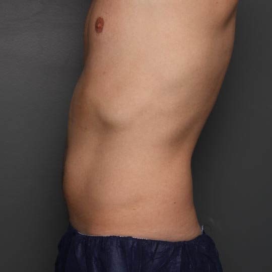 fat injection