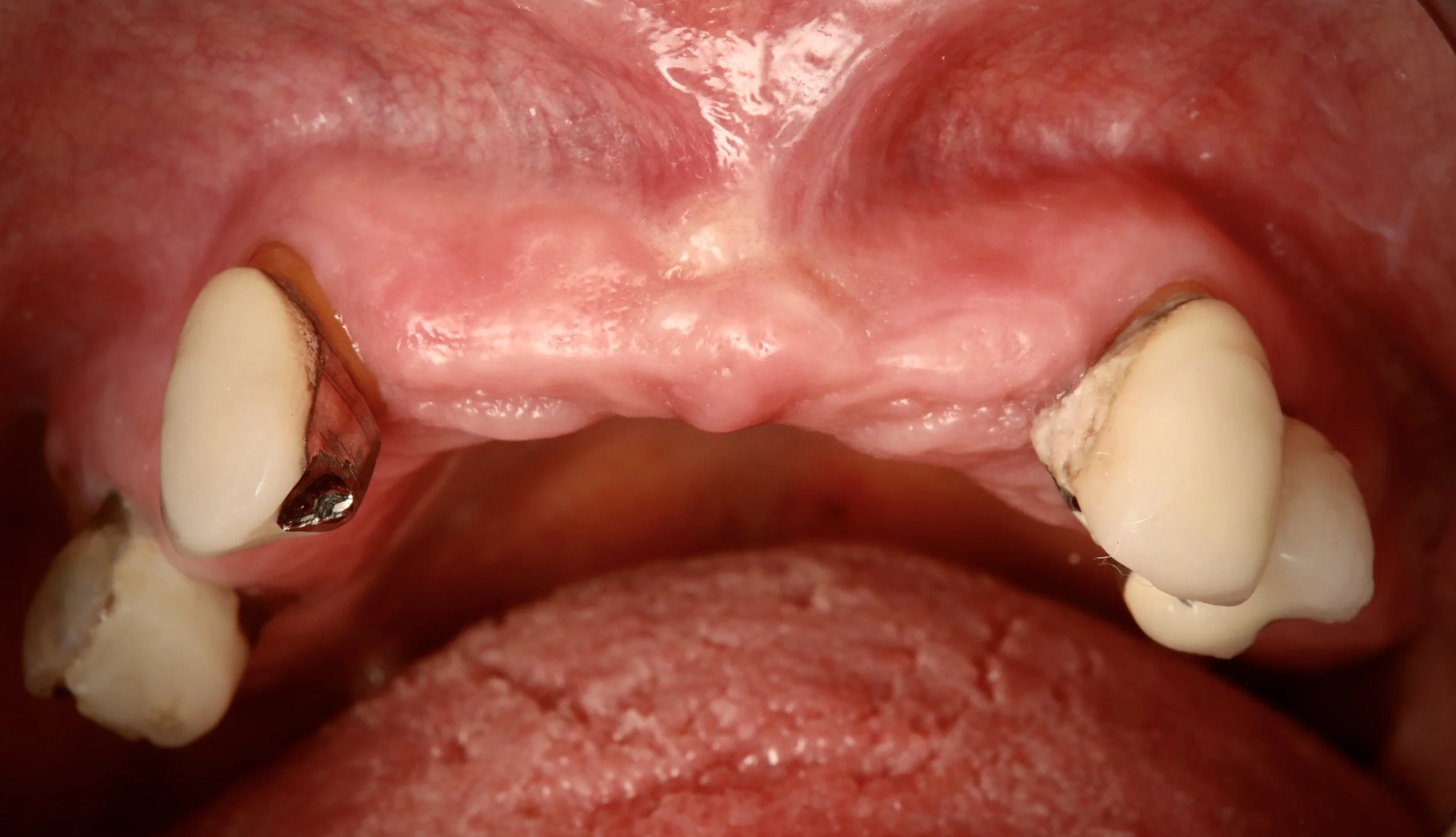 Full arch dental implants — before treatment