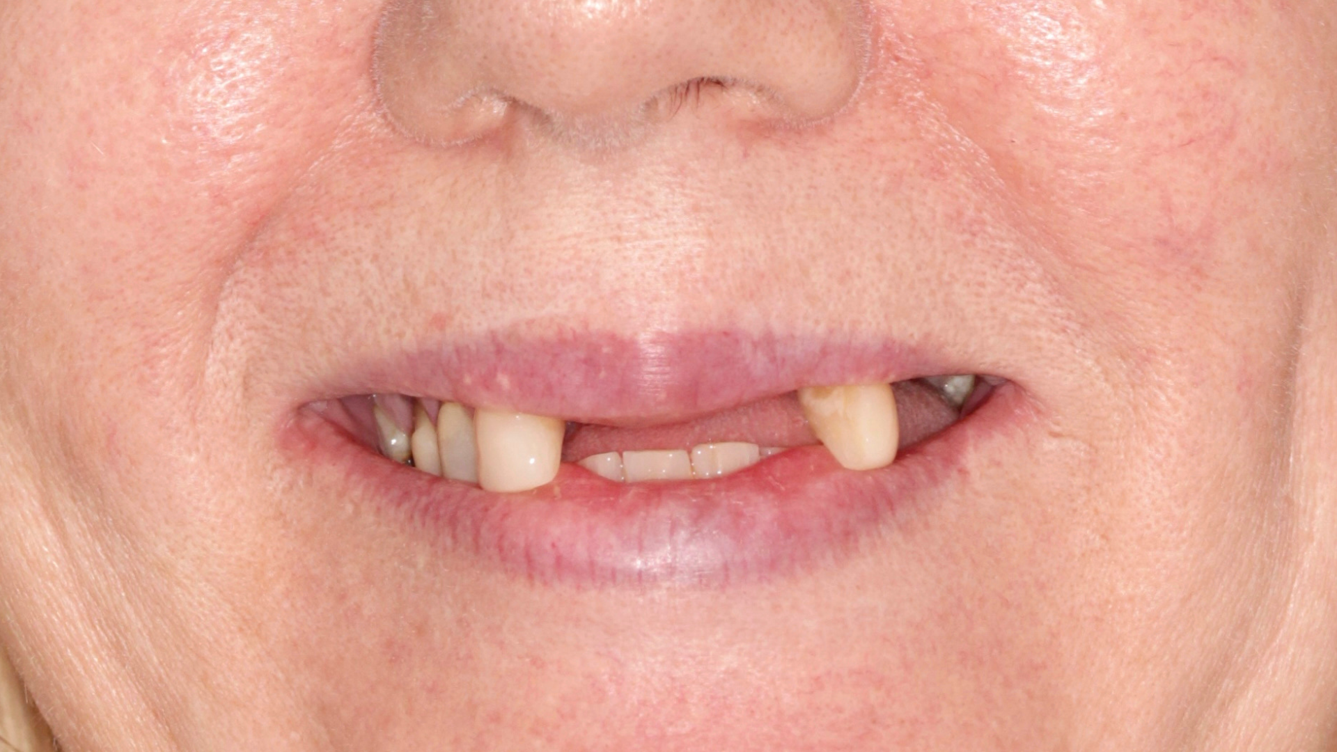 Full arch dental implants — before treatment