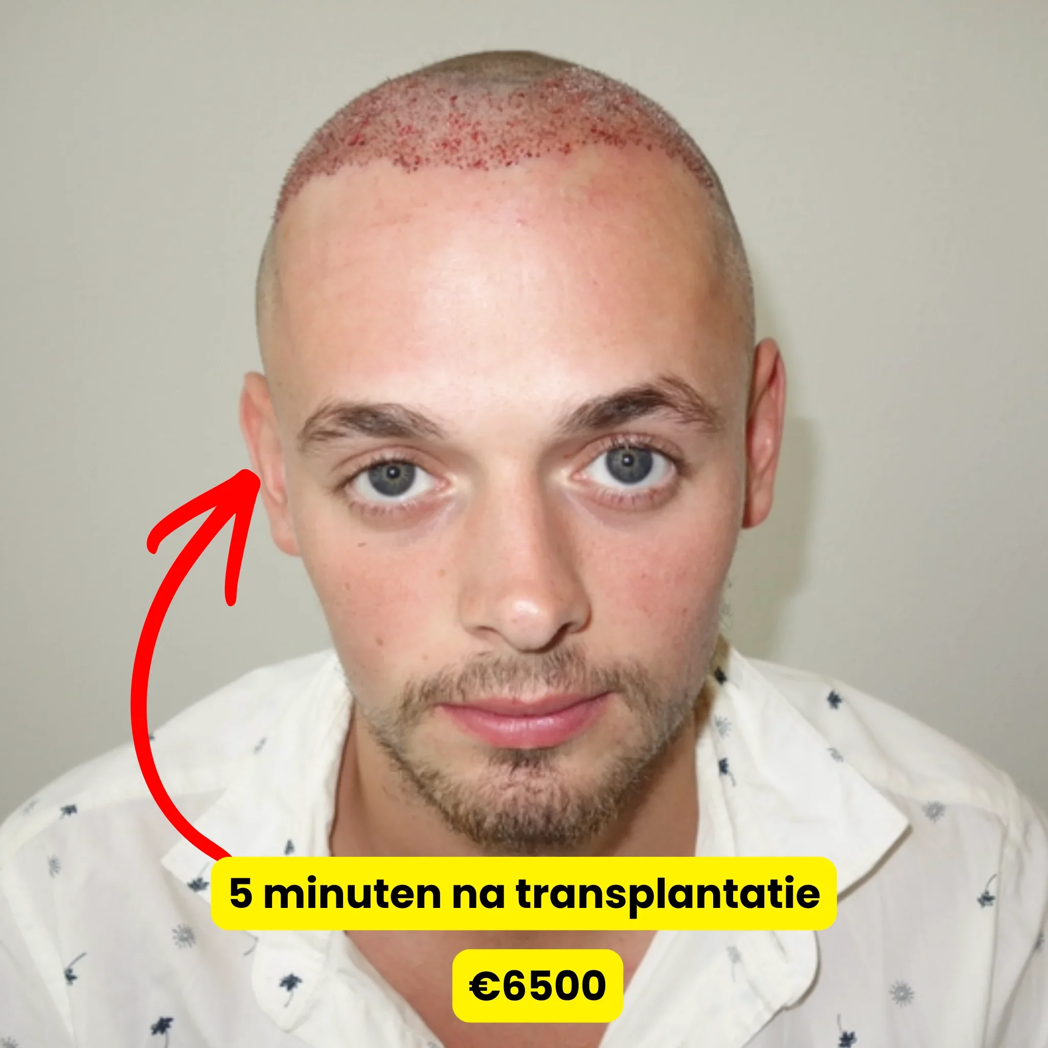 Direct na de haartransplantatie