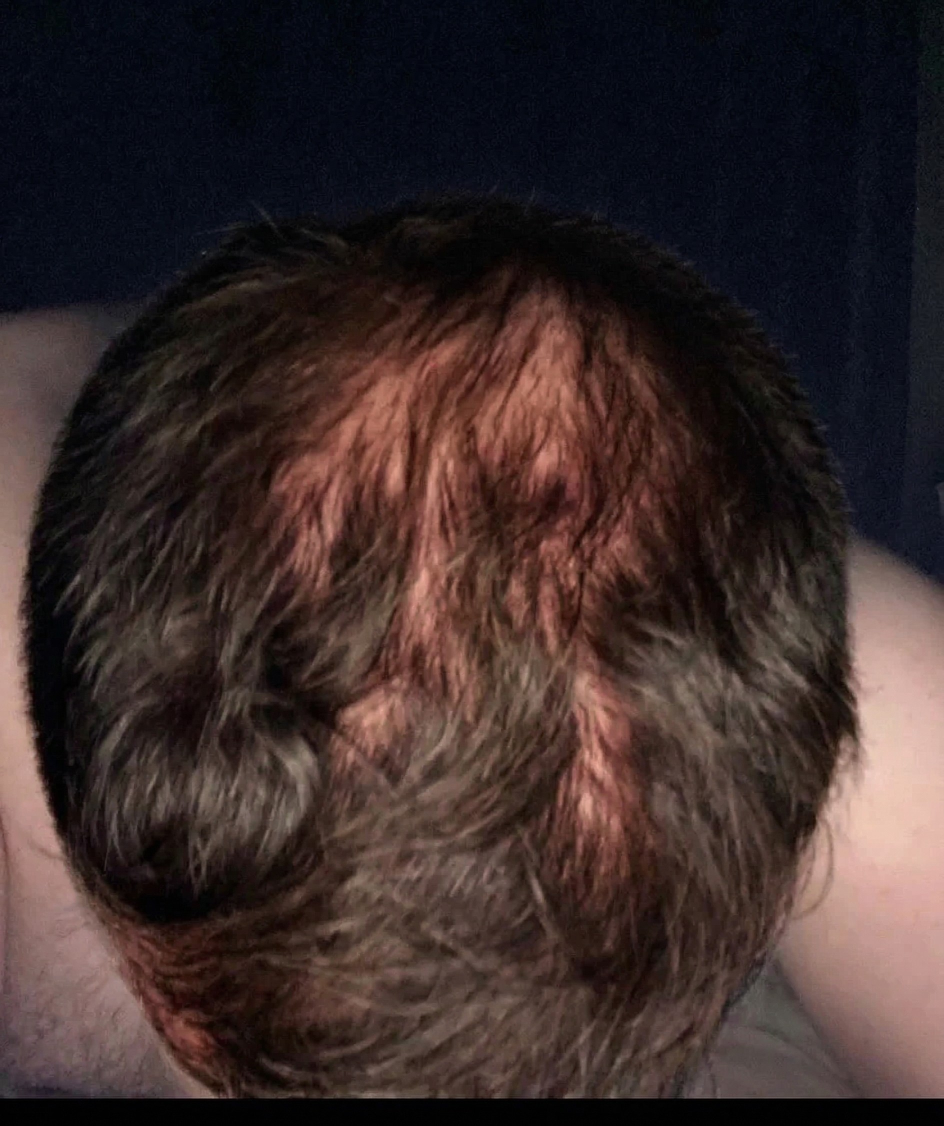 Foto haar kruin en inhammen