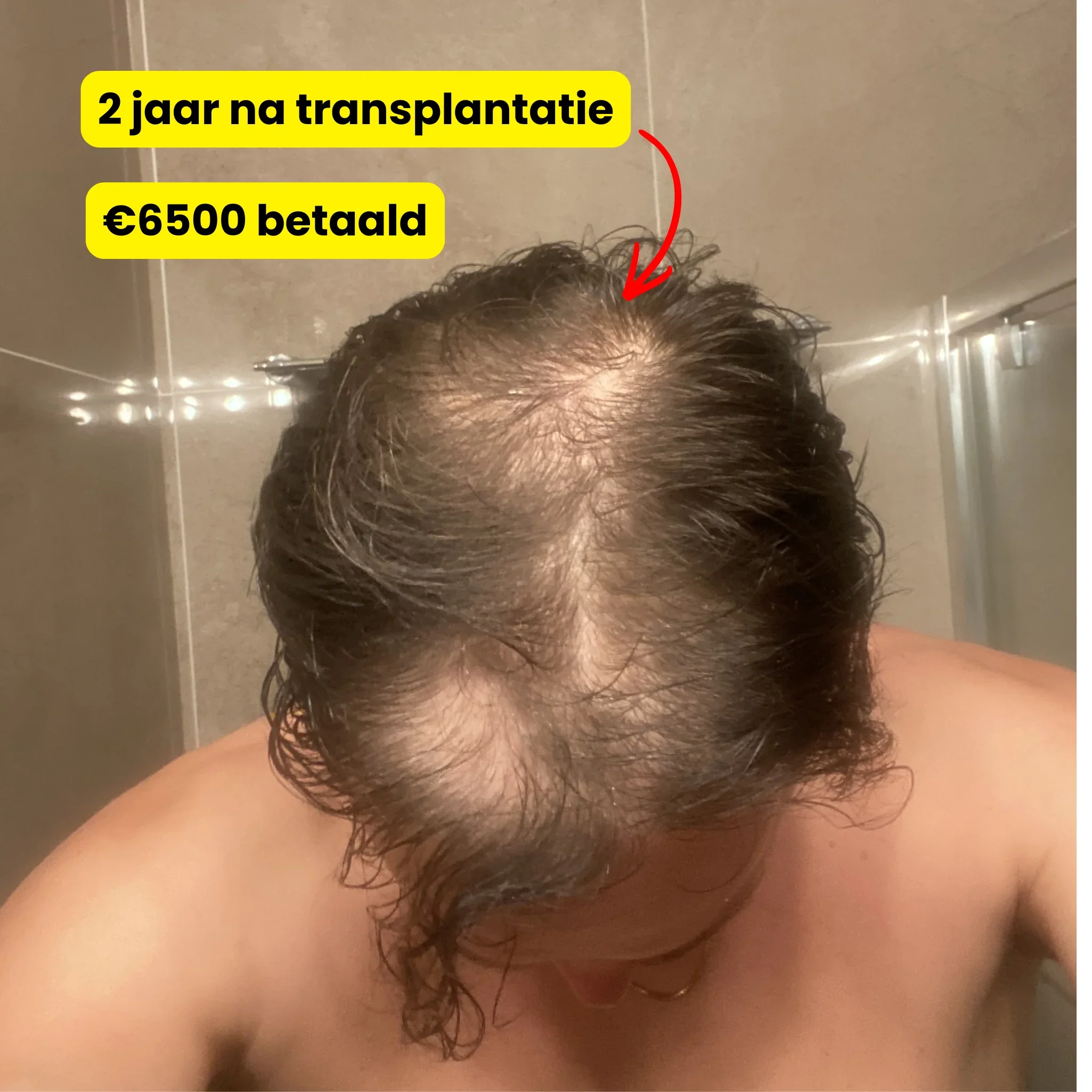 2 jaar na de haartransplantatie — kale plekken zichtbaar