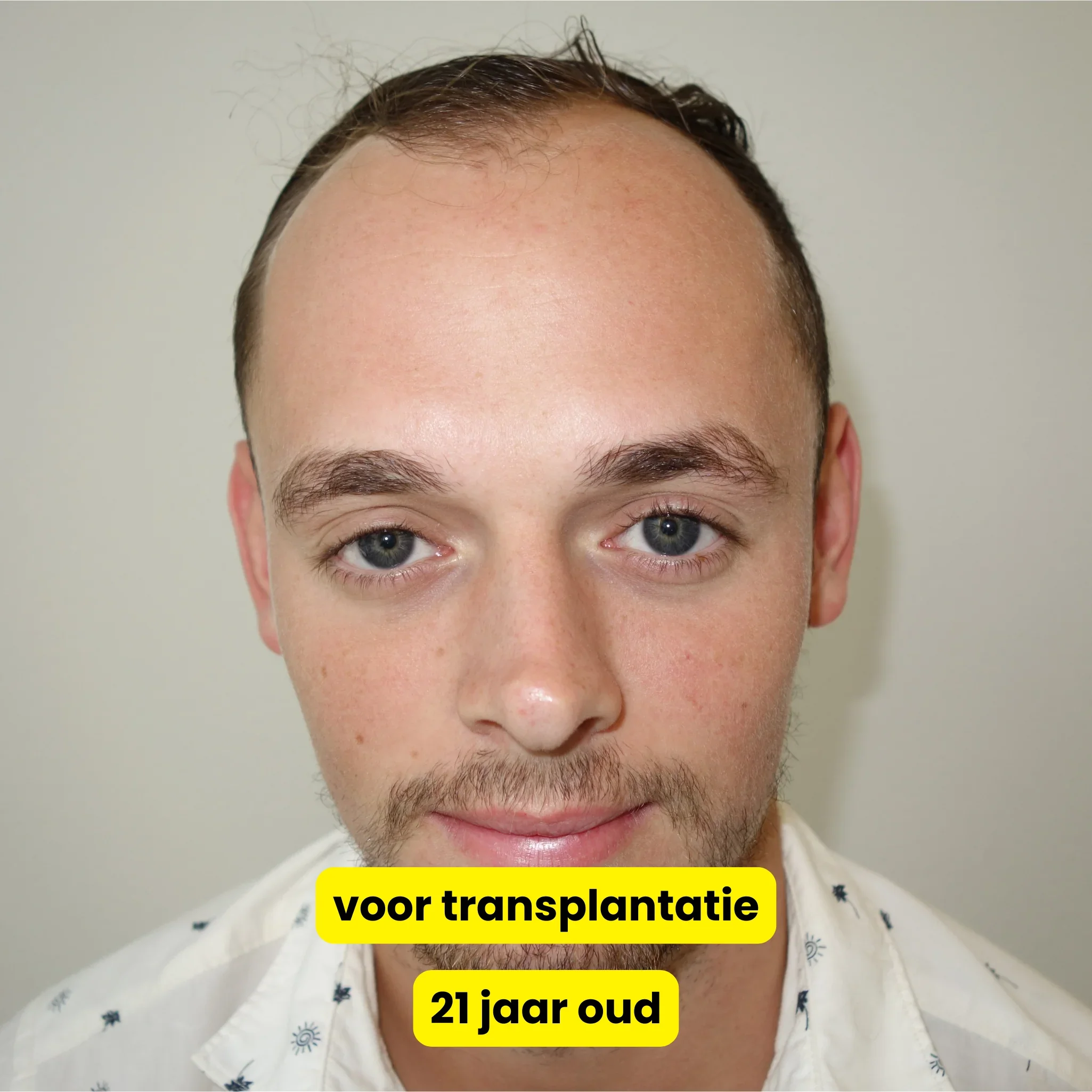 Net voor de haartransplantatie