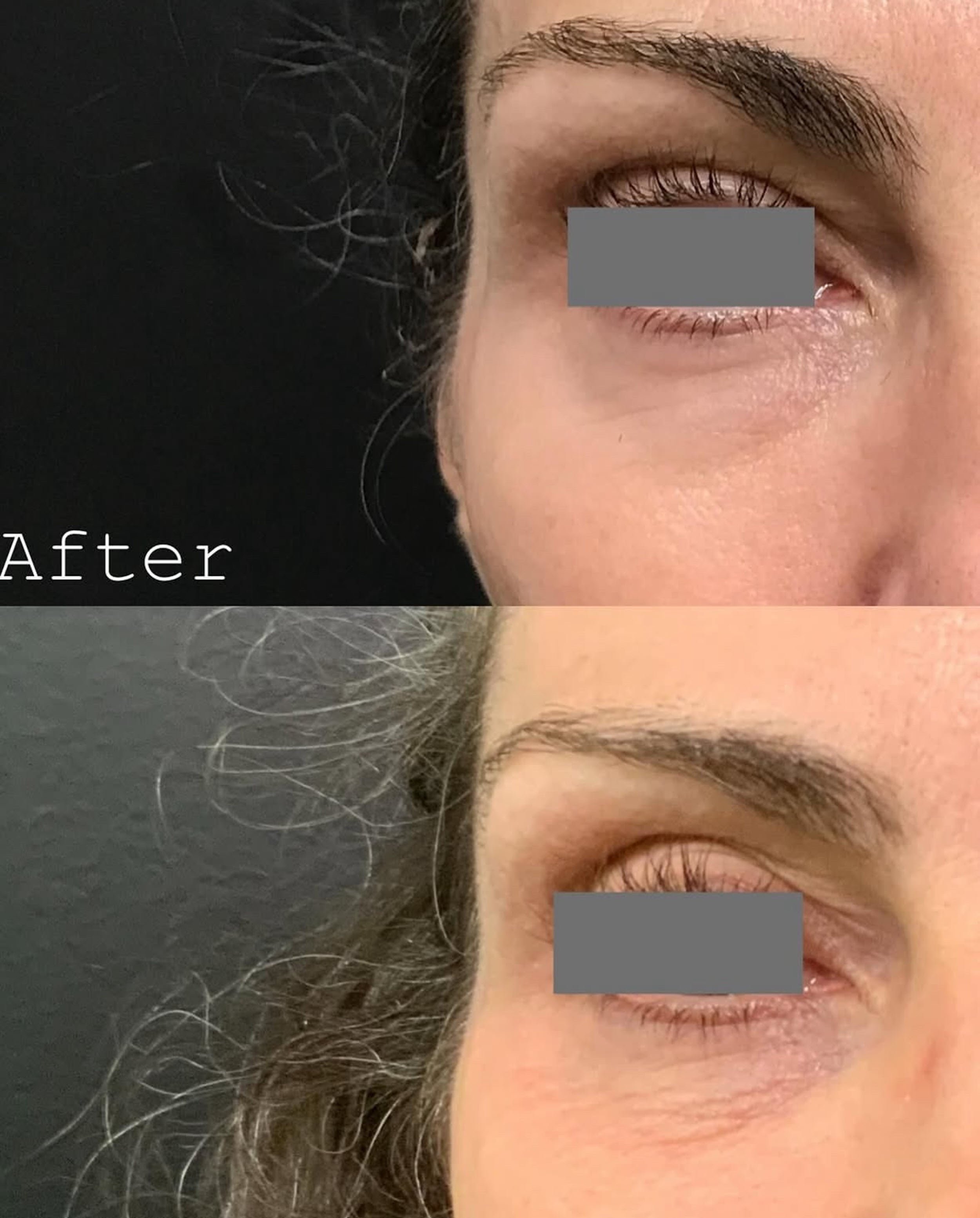 Sublative RF resurfacing eye-area before and after — actual Spa 35 client