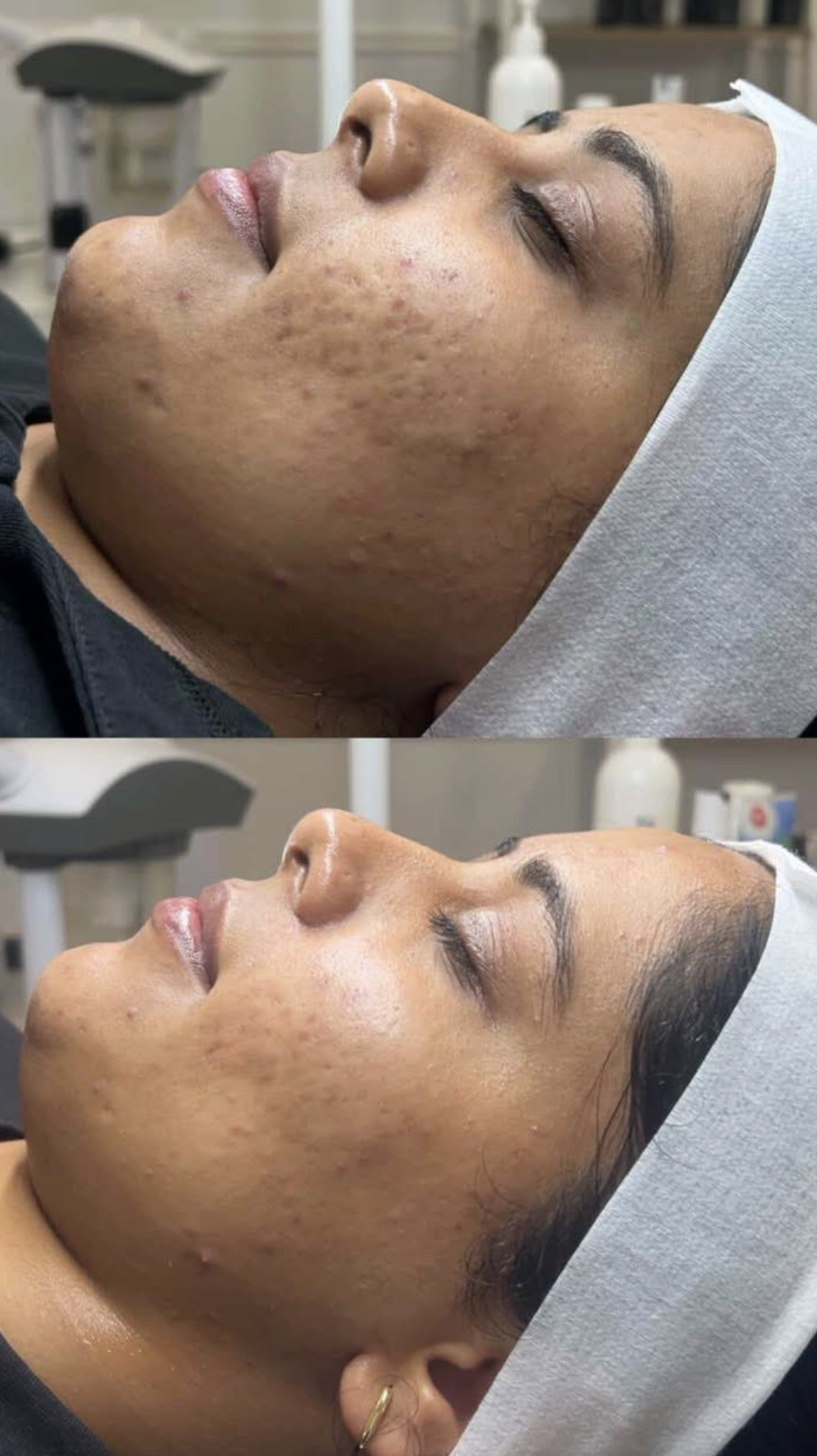 Before and after microneedling with BioRePeel showing smoother skin and reduced acne scarring on deeper skin