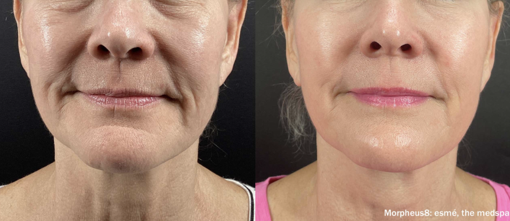 Morpheus8 Face Results