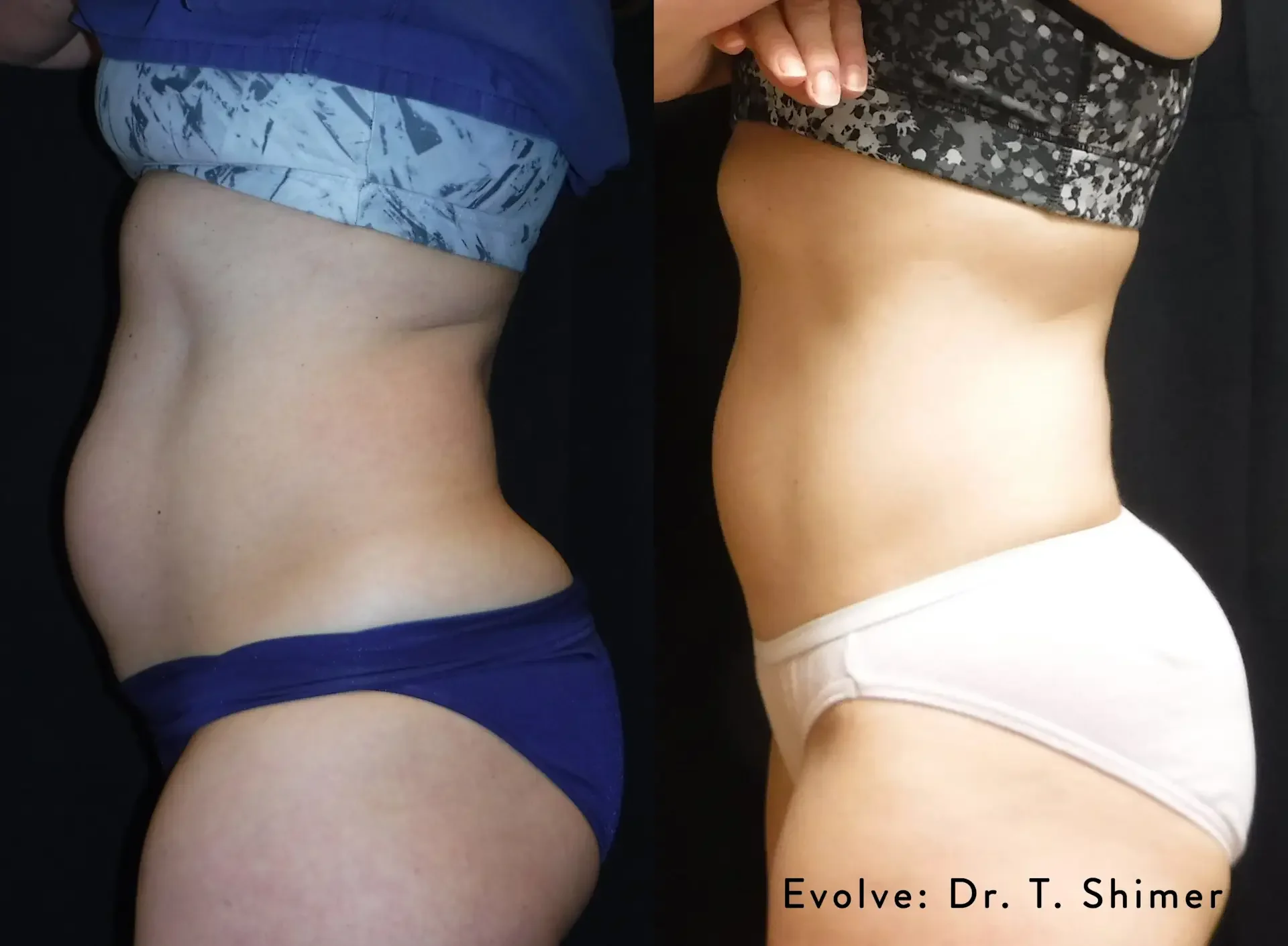 Evolve before and after result