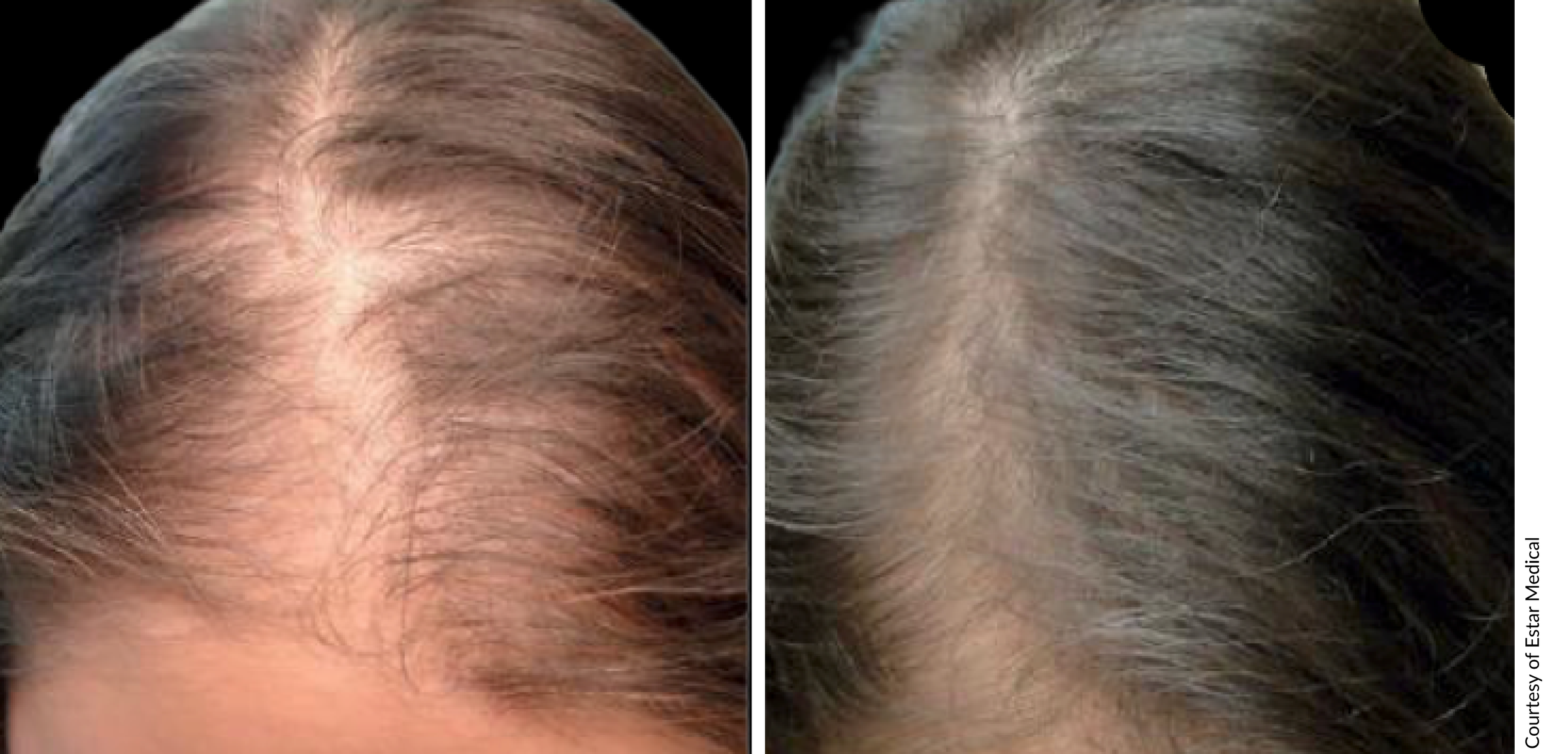 PRP hair restoration before and after