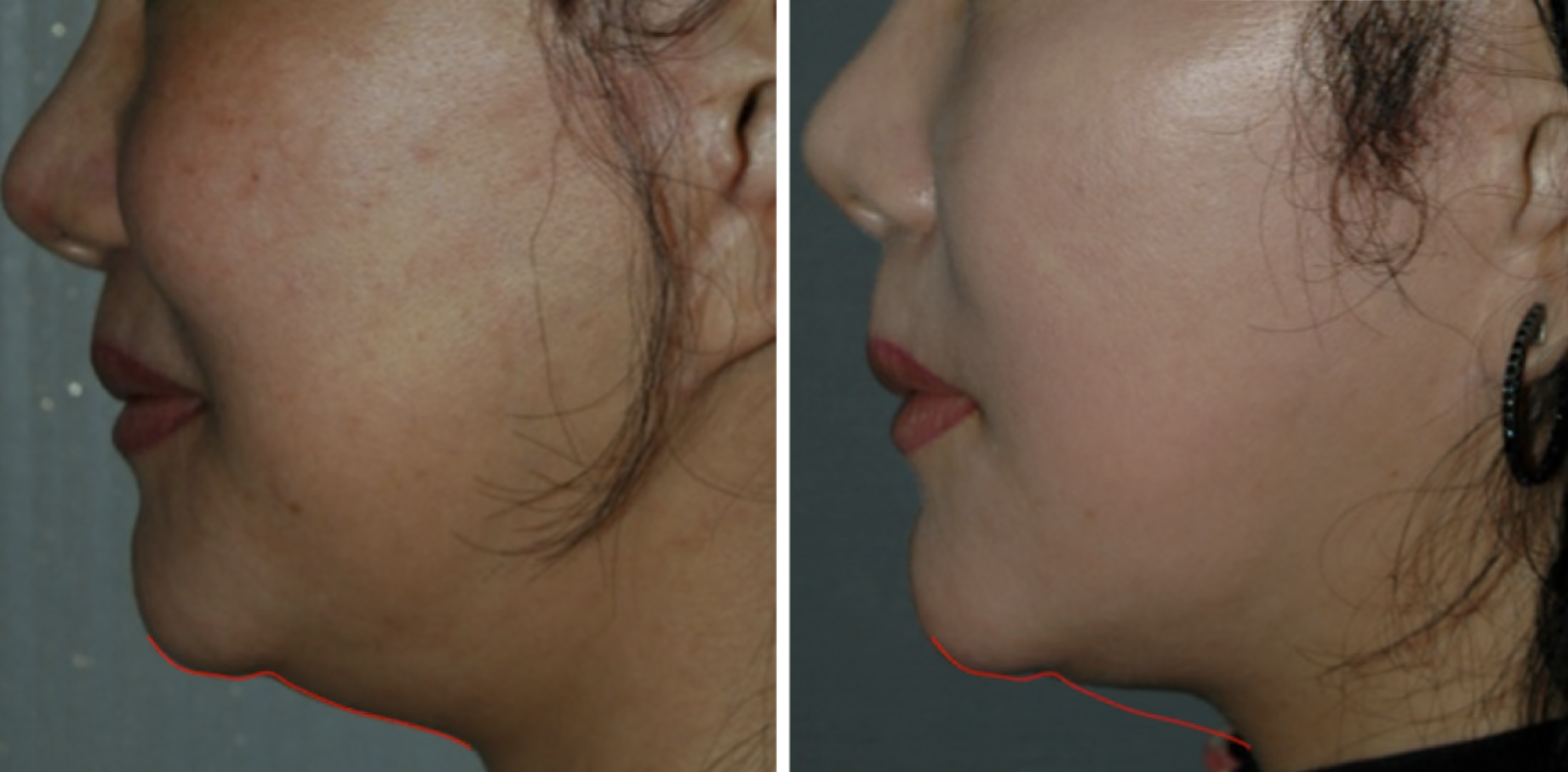Scarlet Pro Before and After