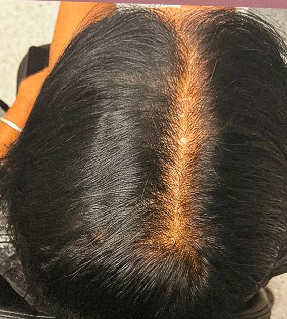 Before Alma TED hair restoration treatment at Elite MedSpa