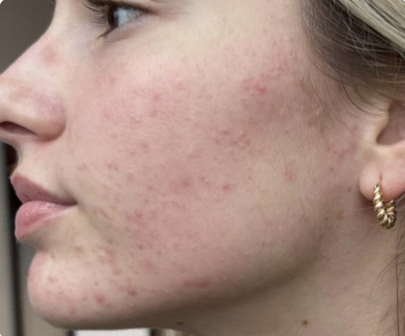 SkinPen Before