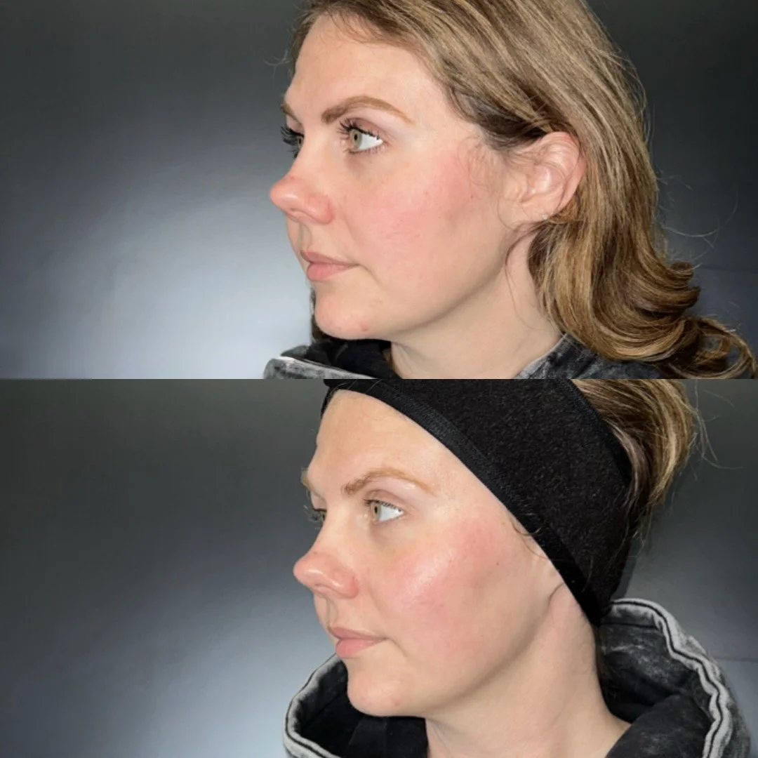 Facial before and after