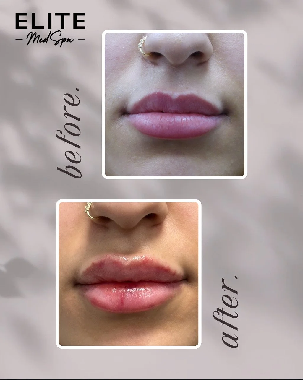 Lip filler before and after