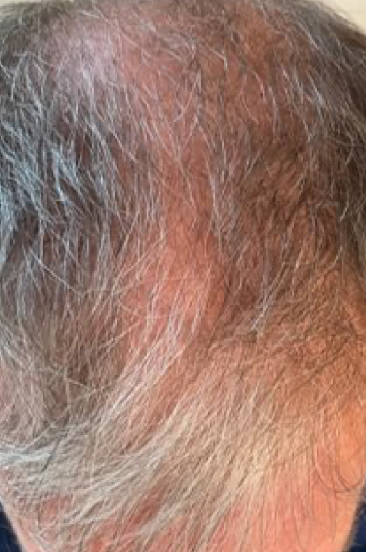 After DE|RIVE hair restoration treatment at Elite MedSpa