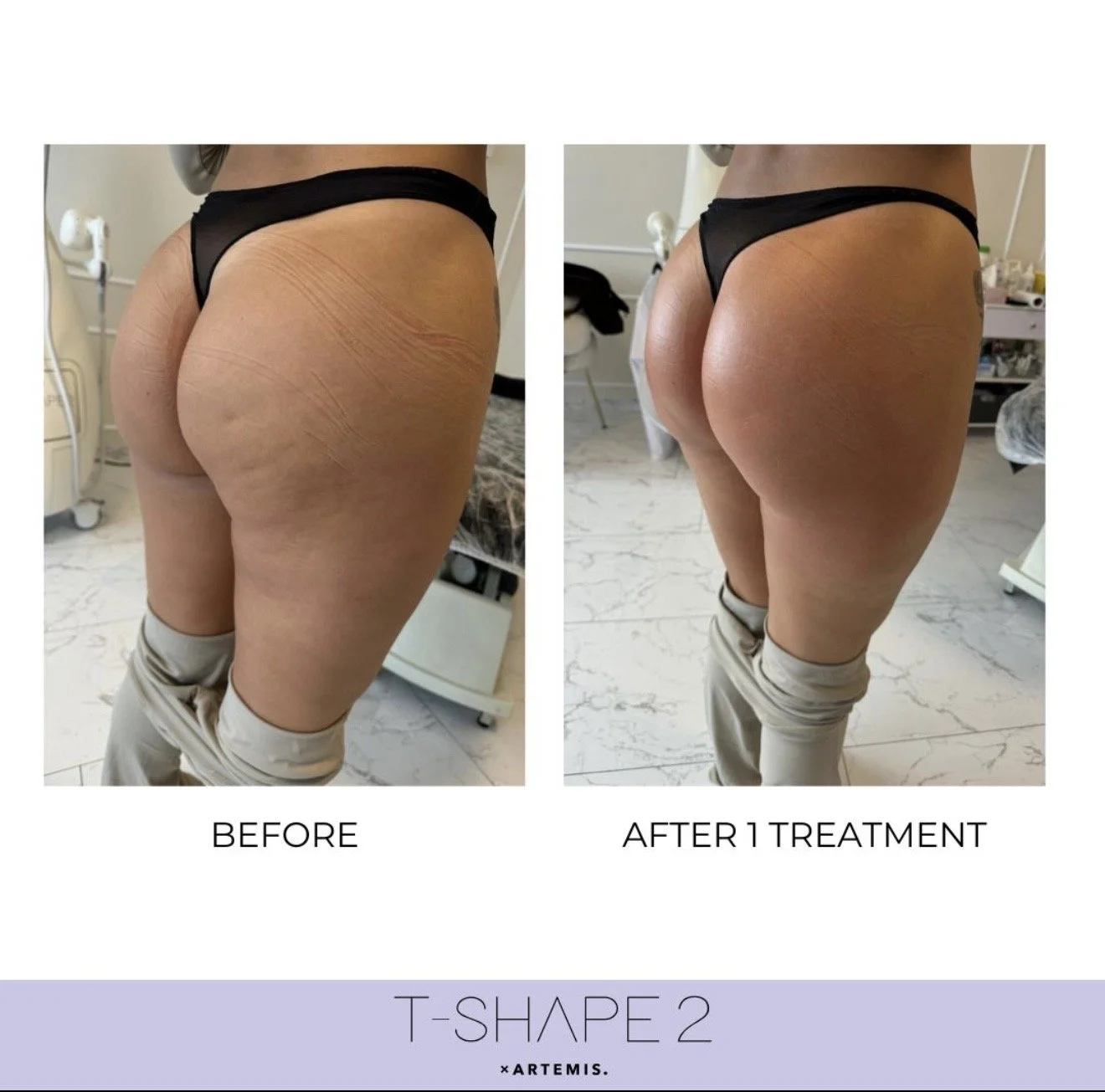 T-Shape 2 before and after