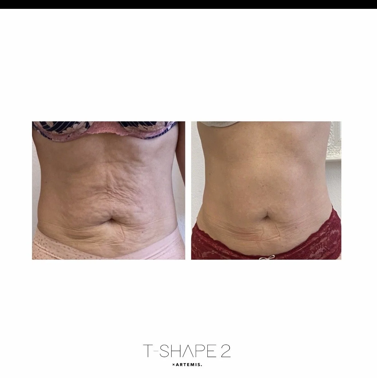 T-Shape 2 before and after result