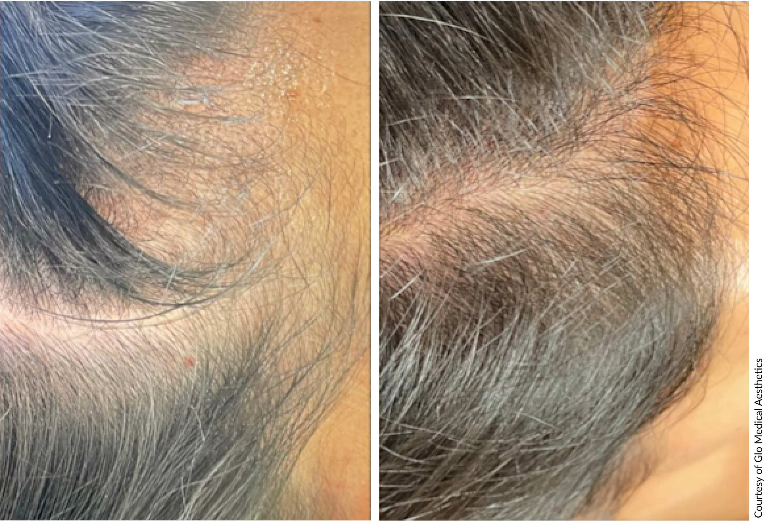 DE|RIVE hair restoration before and after