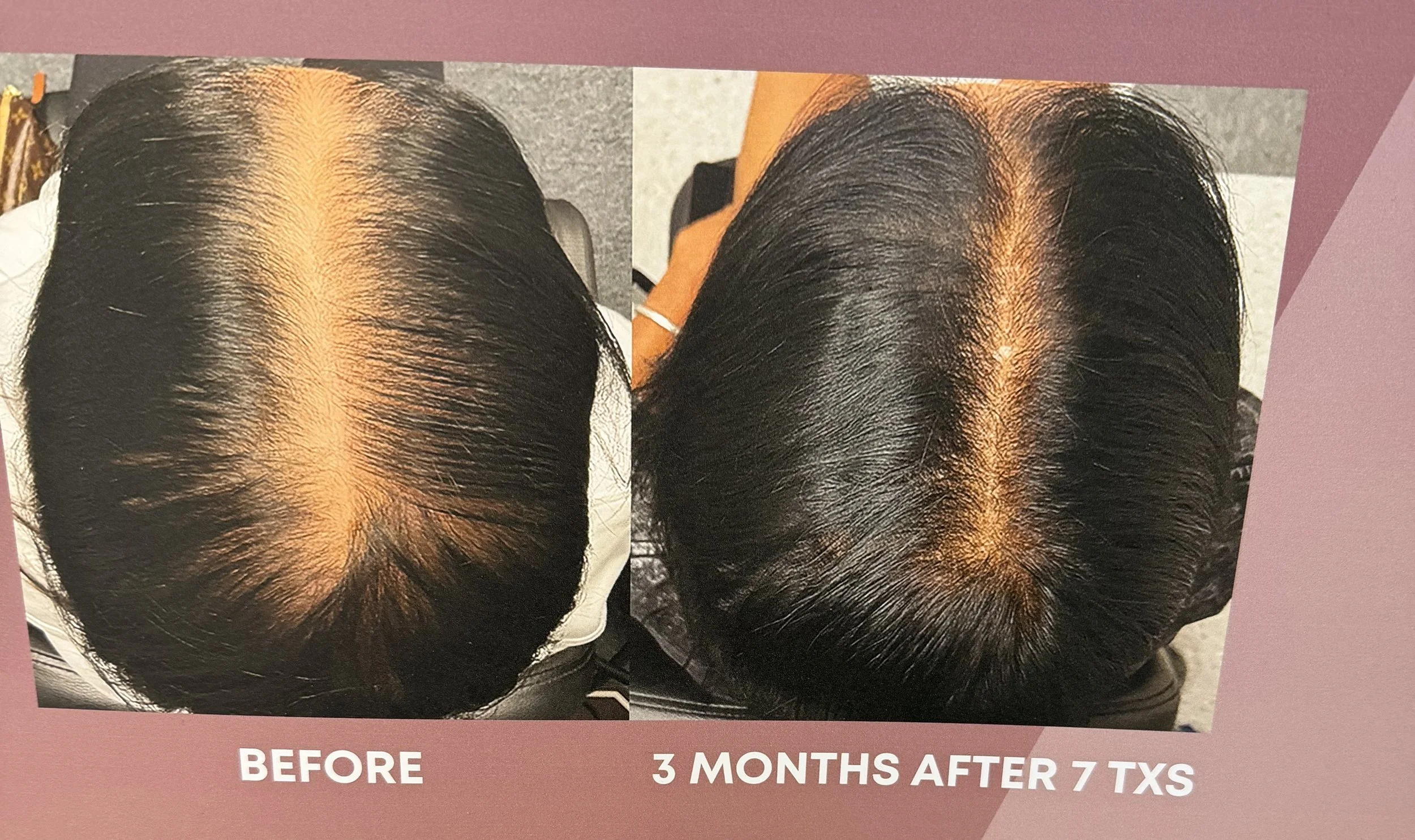 Alma TED before and after hair restoration result