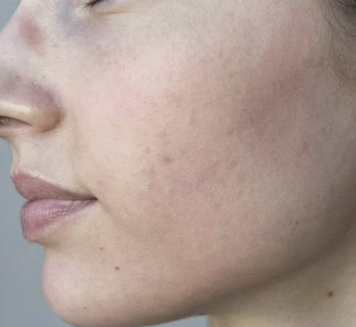 SkinPen After