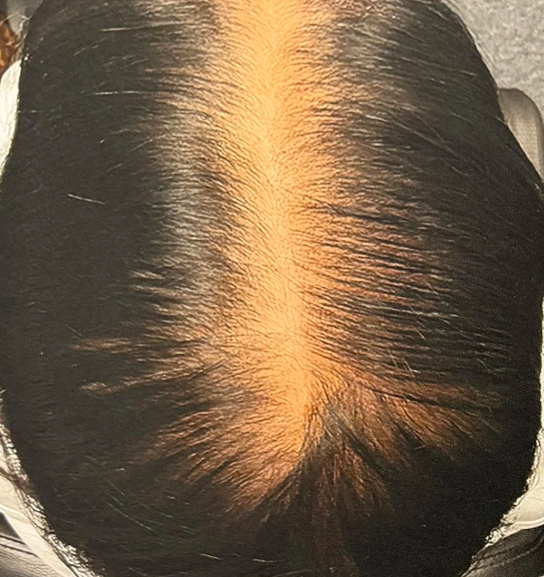 After Alma TED hair restoration treatment at Elite MedSpa