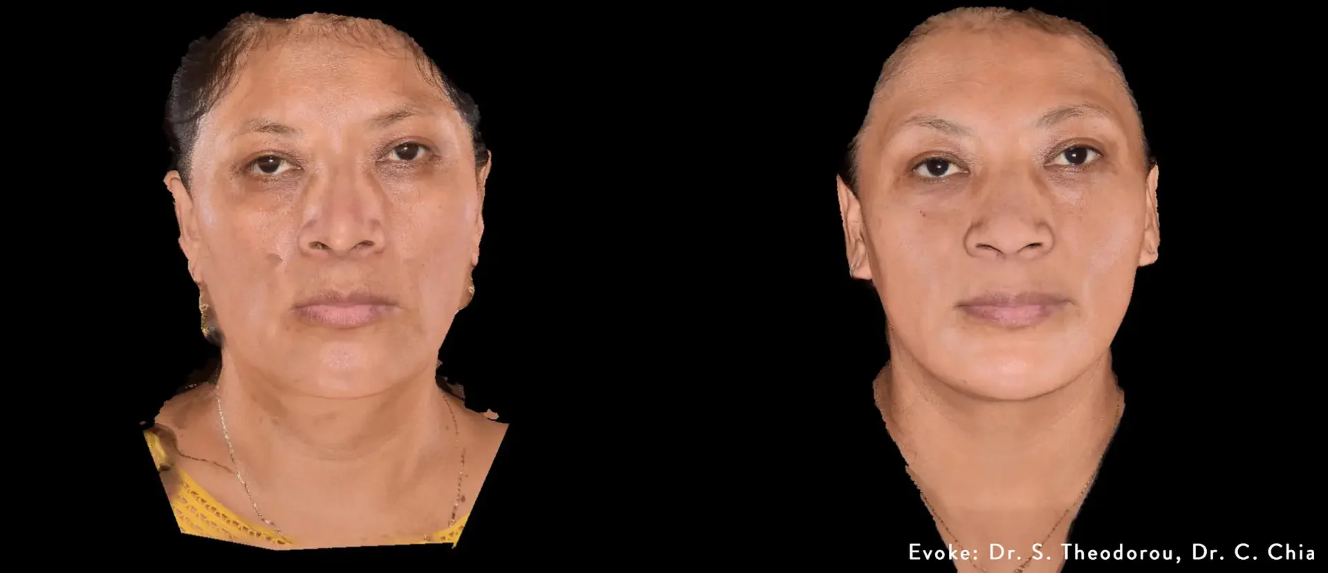 Evoke before and after result