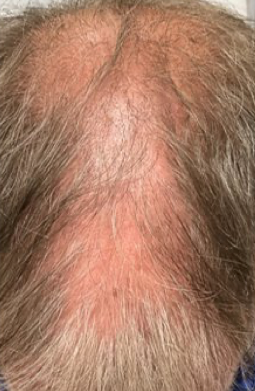 Before DE|RIVE hair restoration treatment at Elite MedSpa