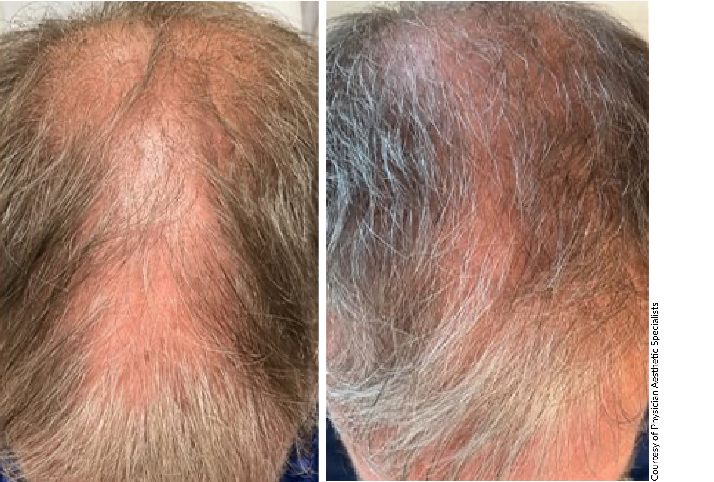 DE|RIVE before and after hair restoration result