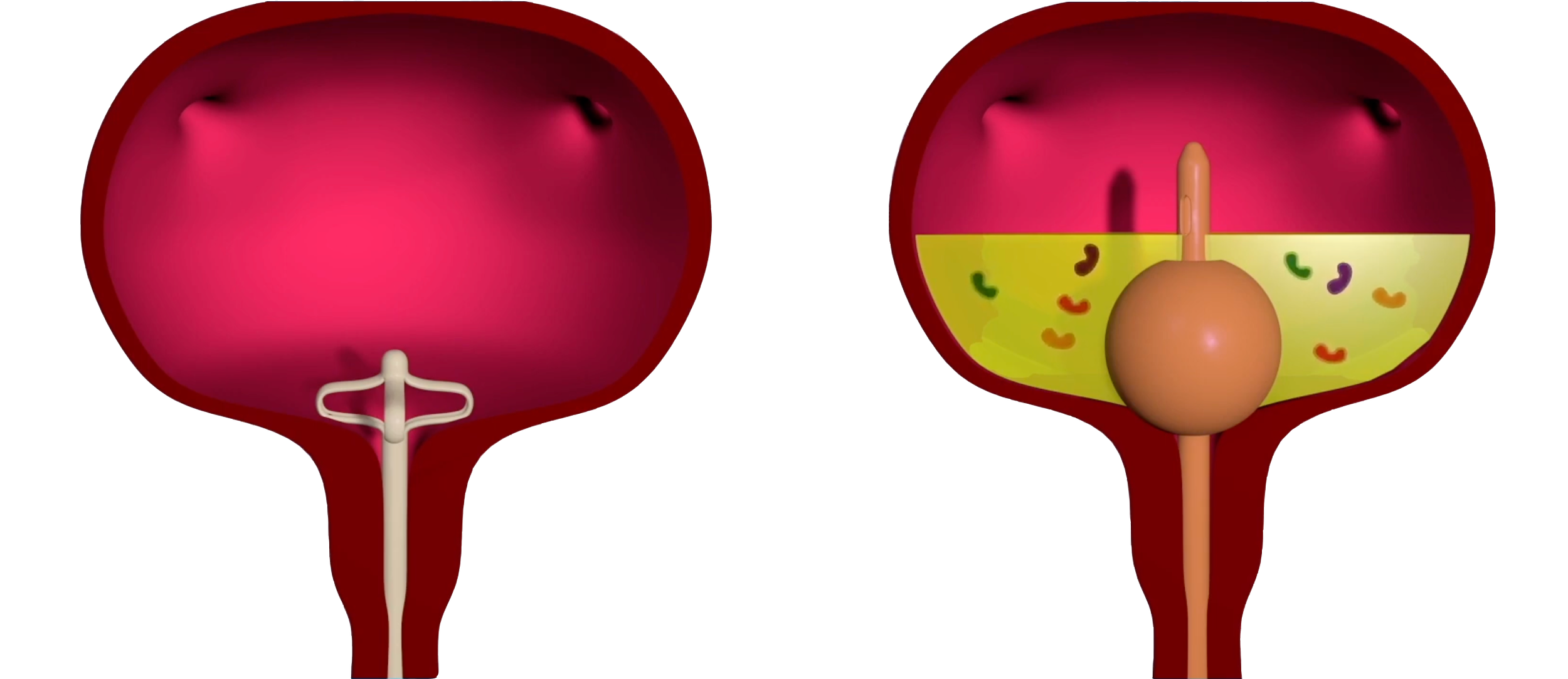 Comparison: Lotus Catheter lumen at the trigone enables near-complete drainage vs Foley balloon elevating lumen above residual urine