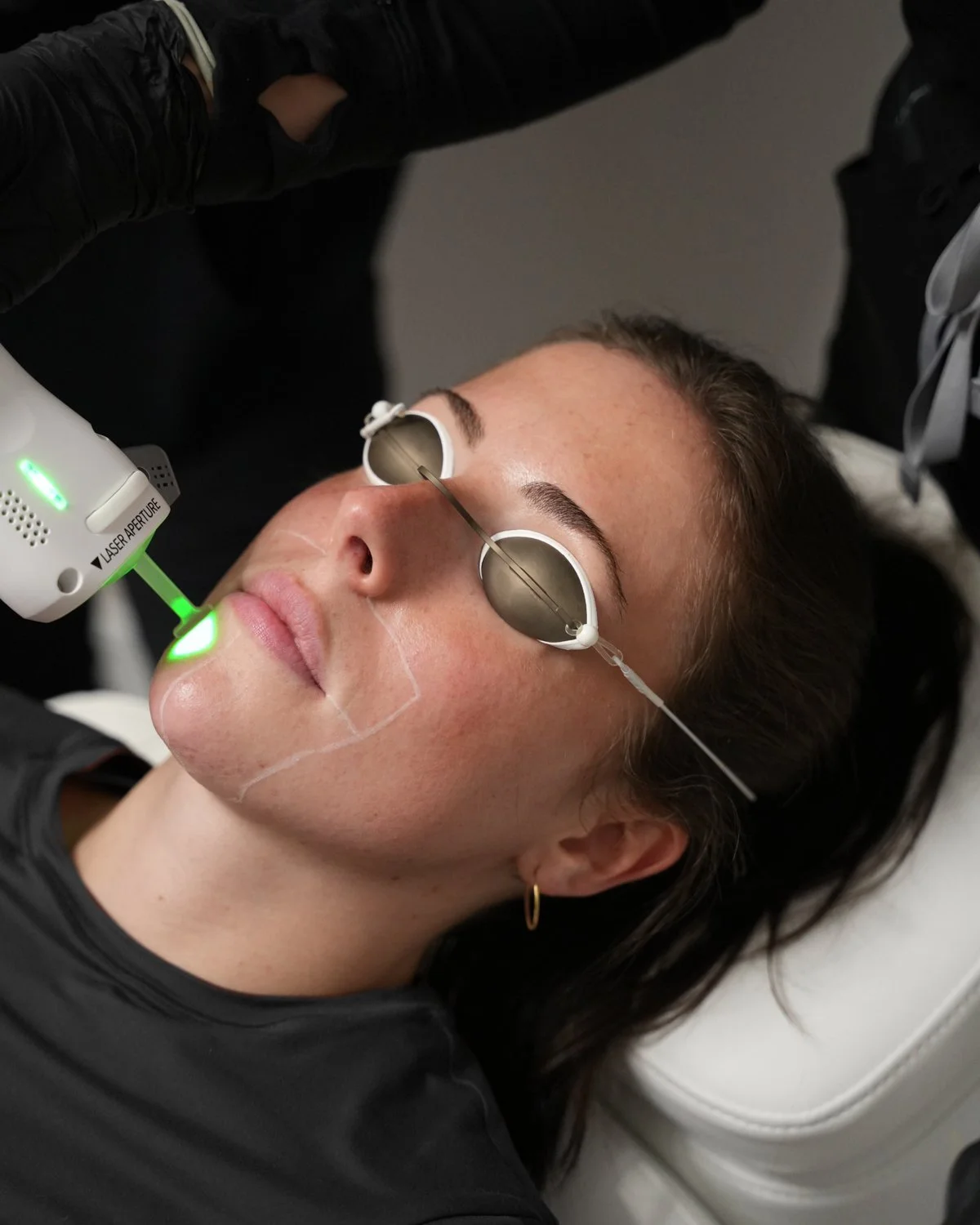Clarity II chin hair removal treatment with protective eye shields at Youth Bar.