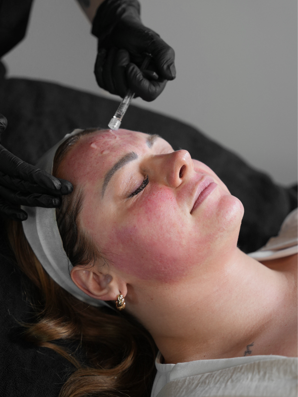 PRP Facial