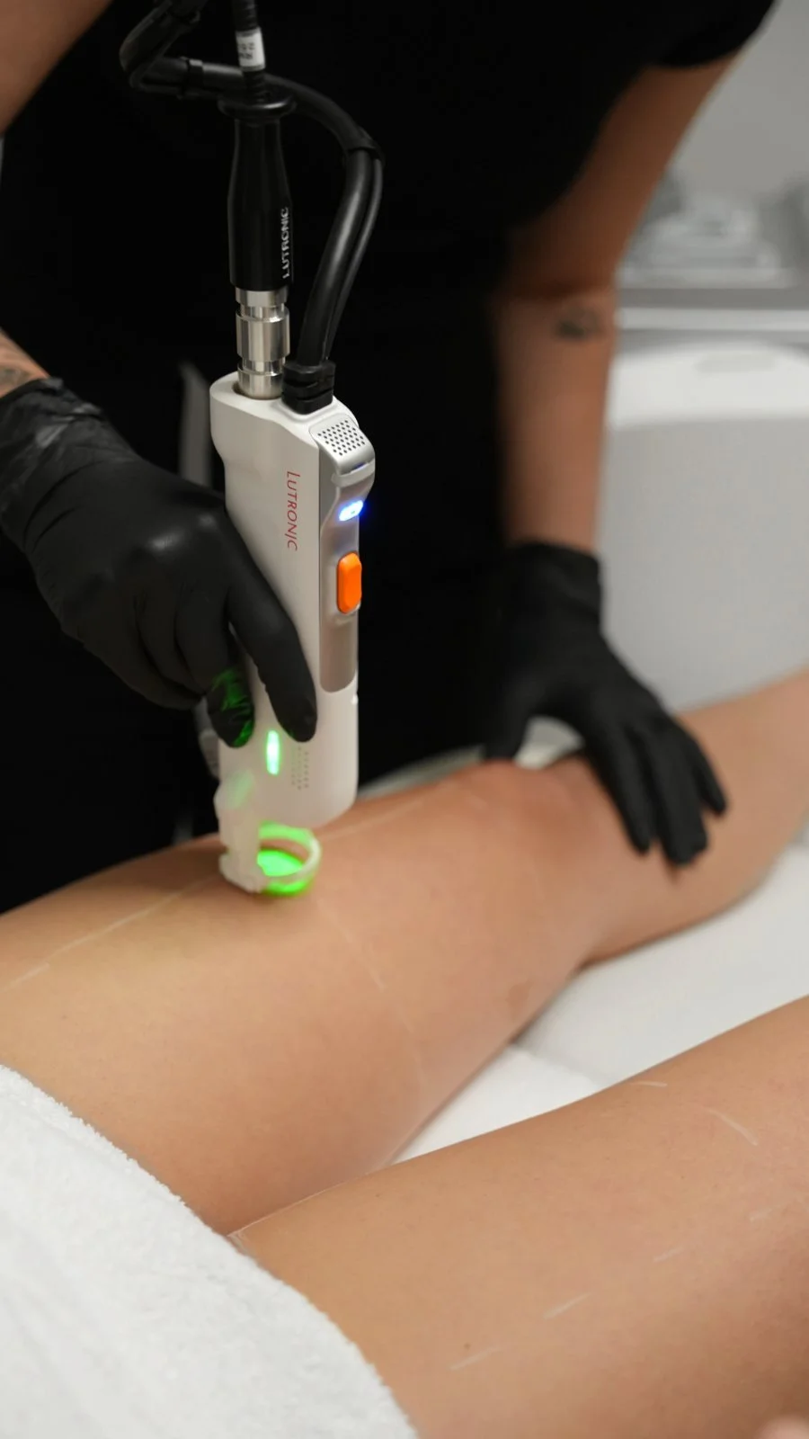 Clarity II laser handpiece treating a lower leg at Youth Bar.
