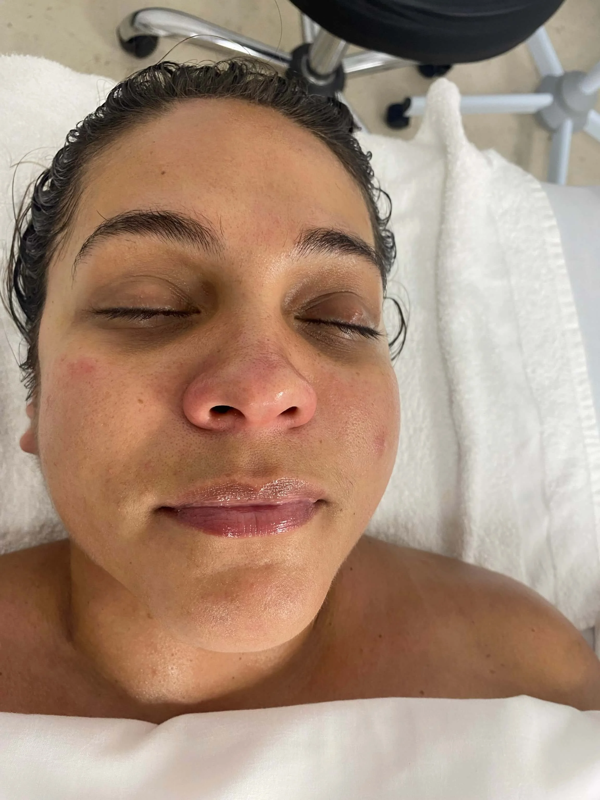 Katie T. — after microcurrent treatment