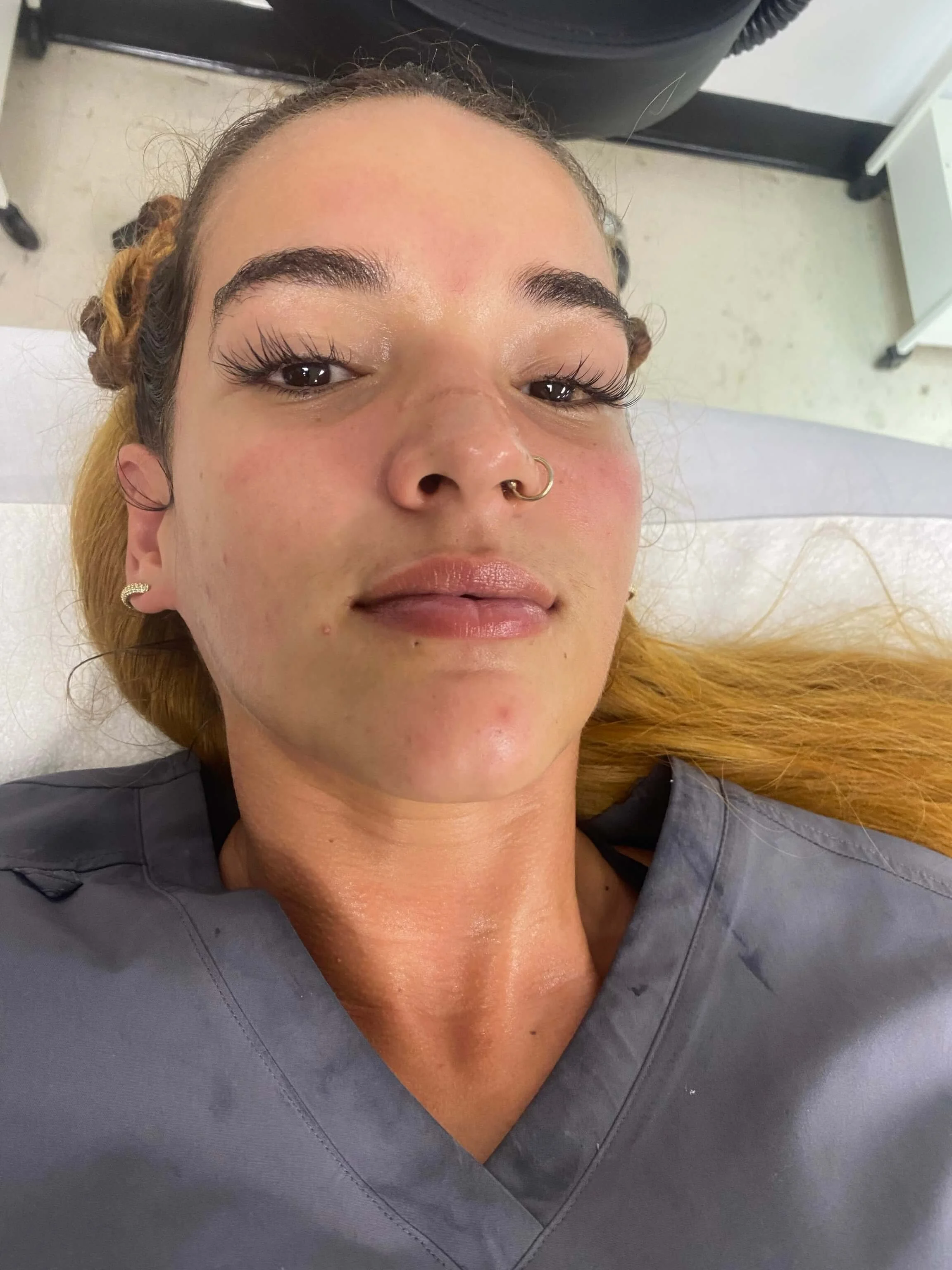 Emily — after treatment