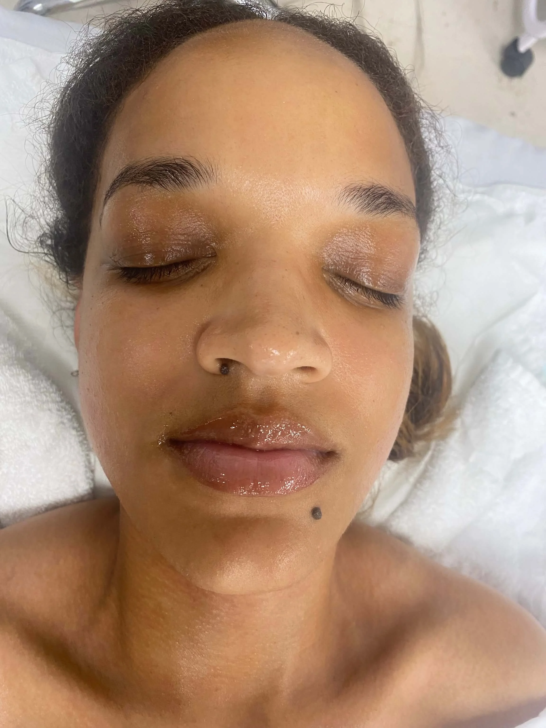 Melissa — post-treatment glow