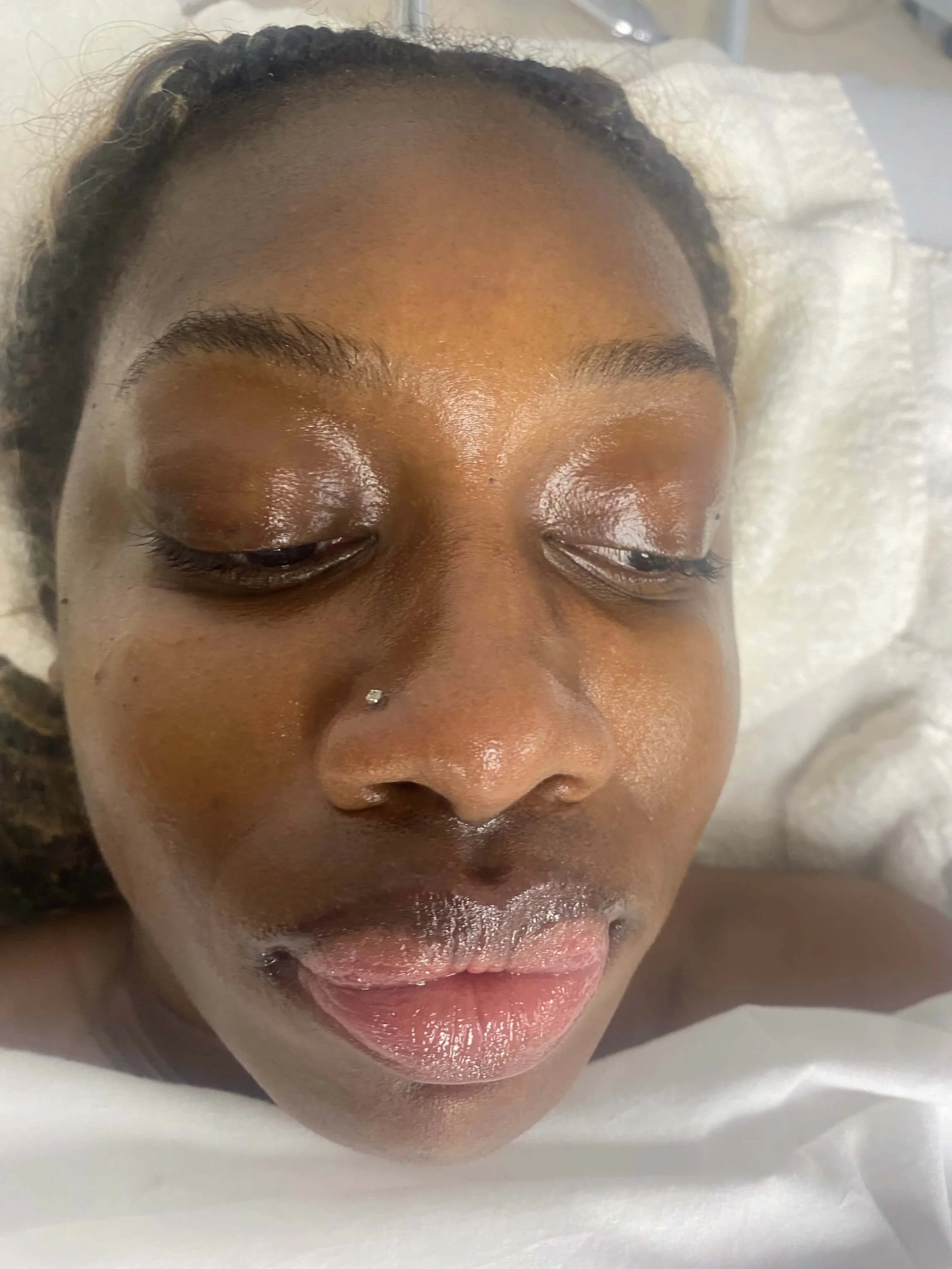 Ashley — during treatment