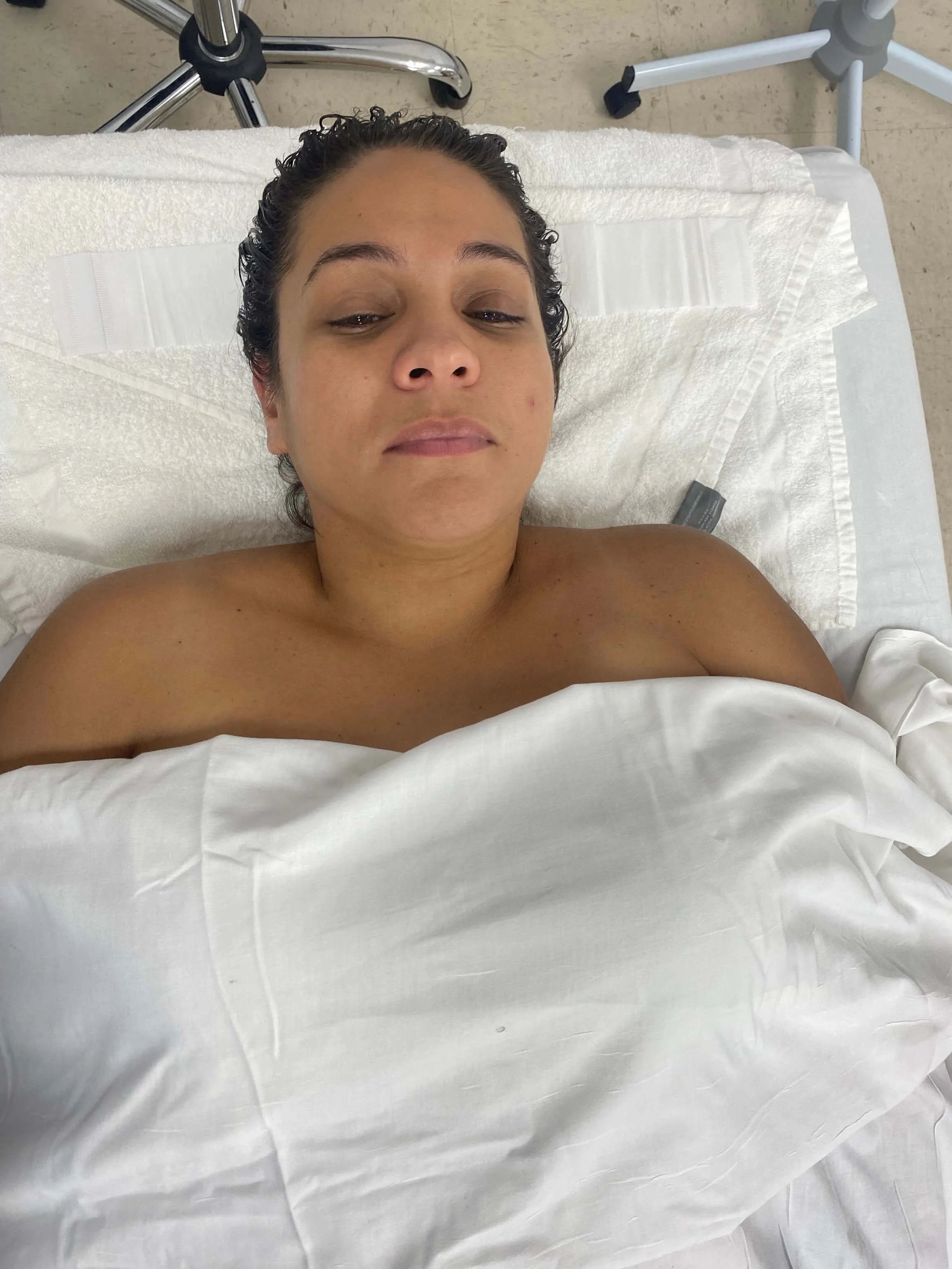 Katie T. — before microcurrent treatment
