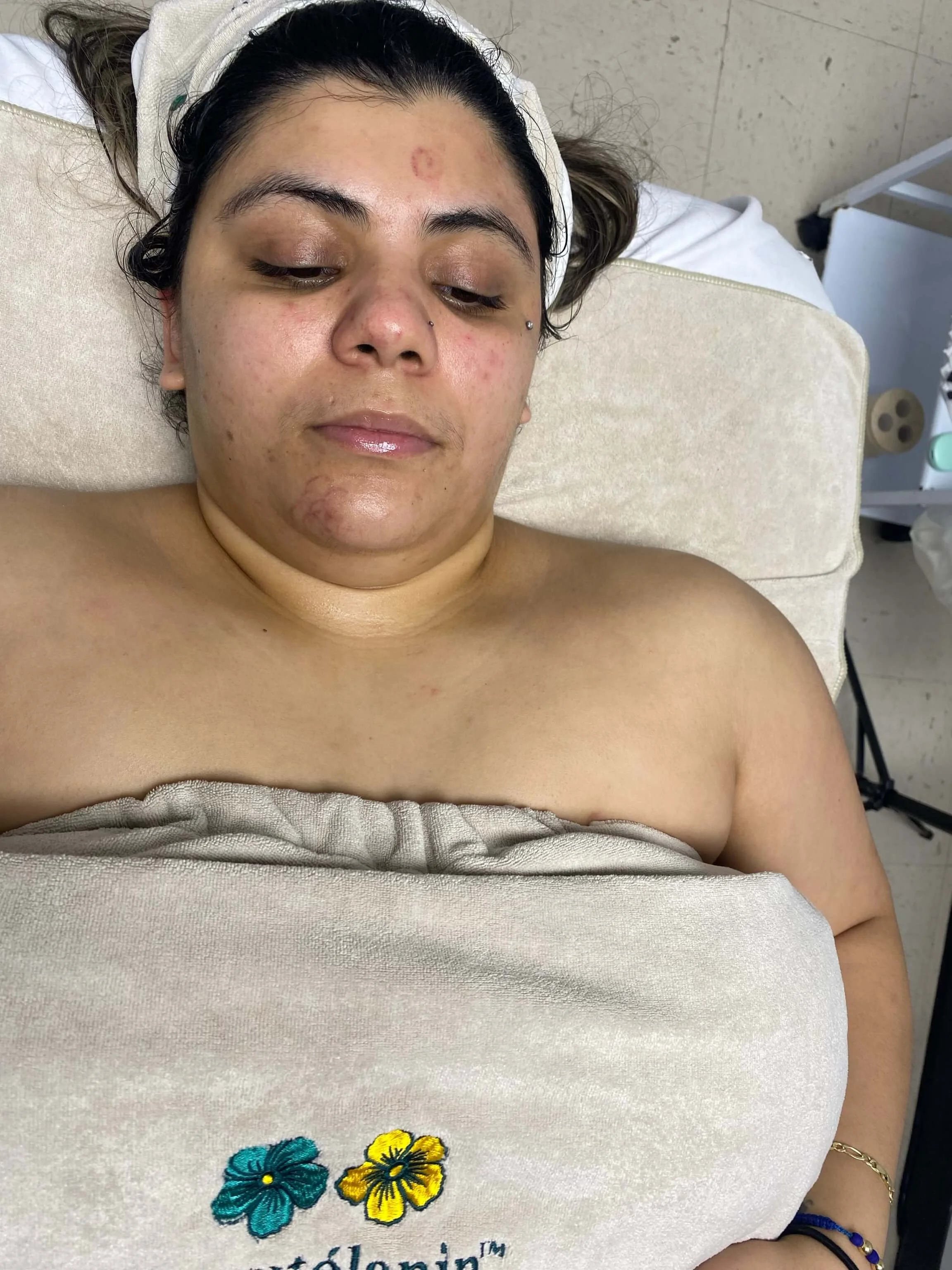 Catherine — during treatment